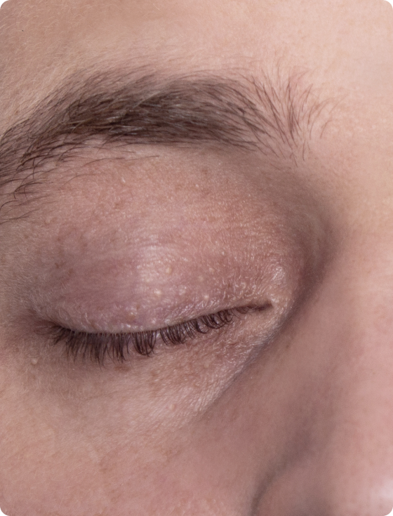 Quistes tipo milium: Belleza y salud en armonía