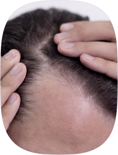 Pérdida de cabello: reparamos los daños
