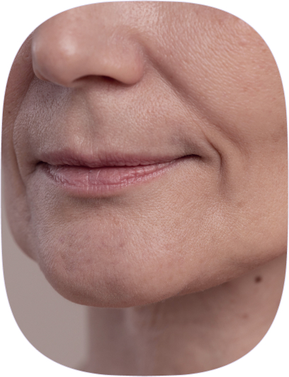 Surcos y hundimientos: Un rostro liso y uniforme